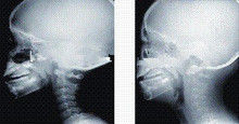 Good price Cakupan Tinta Cakupan Tinggi X-ray Pencitraan Diagnostik, Film Medis x-ray 35 x 43cm on line
