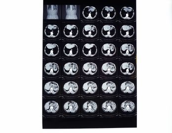 Drypix 2000 X Ray Dry Film 8 x 10 Inch Tahan Scrach Untuk Fuji 3000