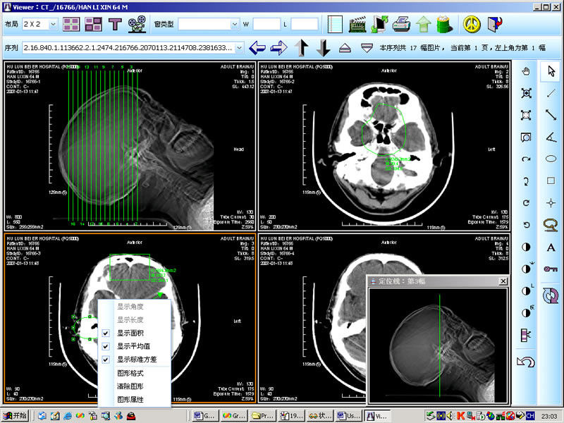 8 x 10 inci Kertas Medis Laser X Ray Pencitraan Diagnostik Untuk KND-DRYTEC 4000