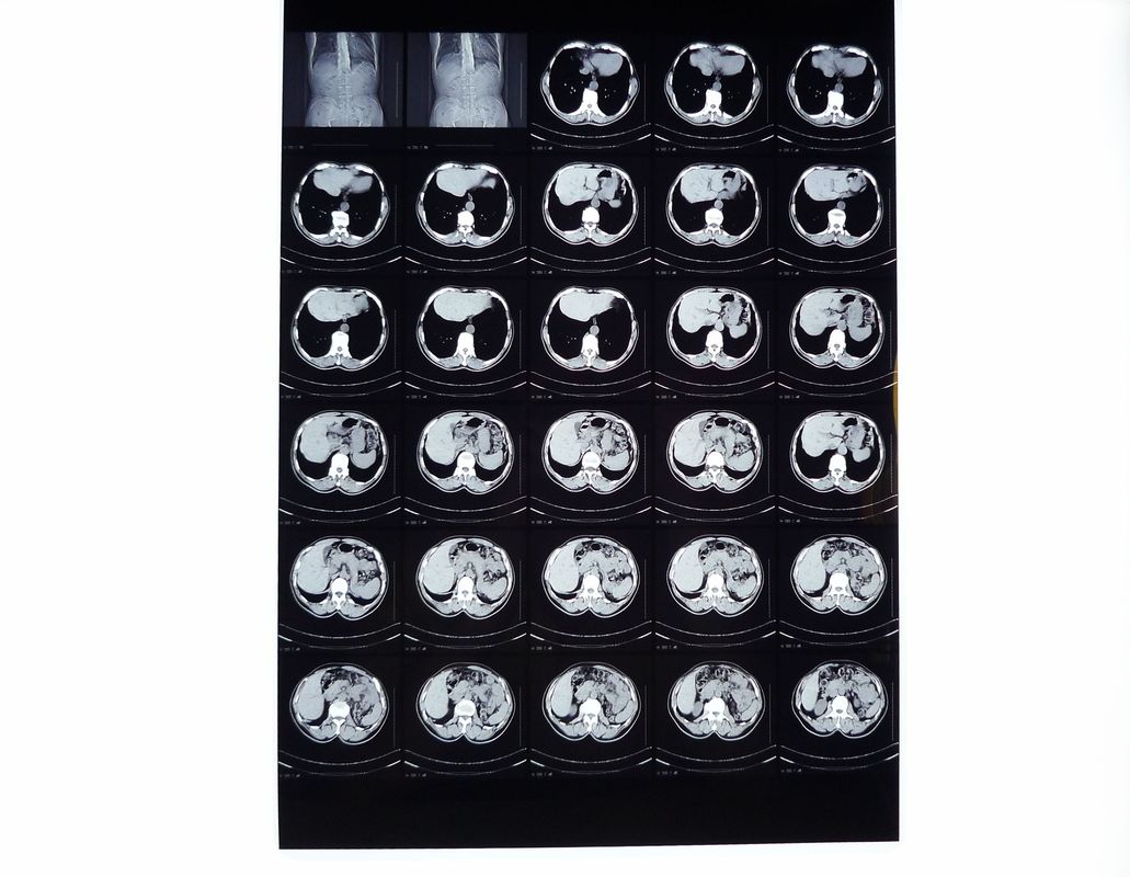 Medis X ray Film, Film Pencitraan Kering Kompatibel Dengan Printer Thermal Untuk CT / DR / MRI