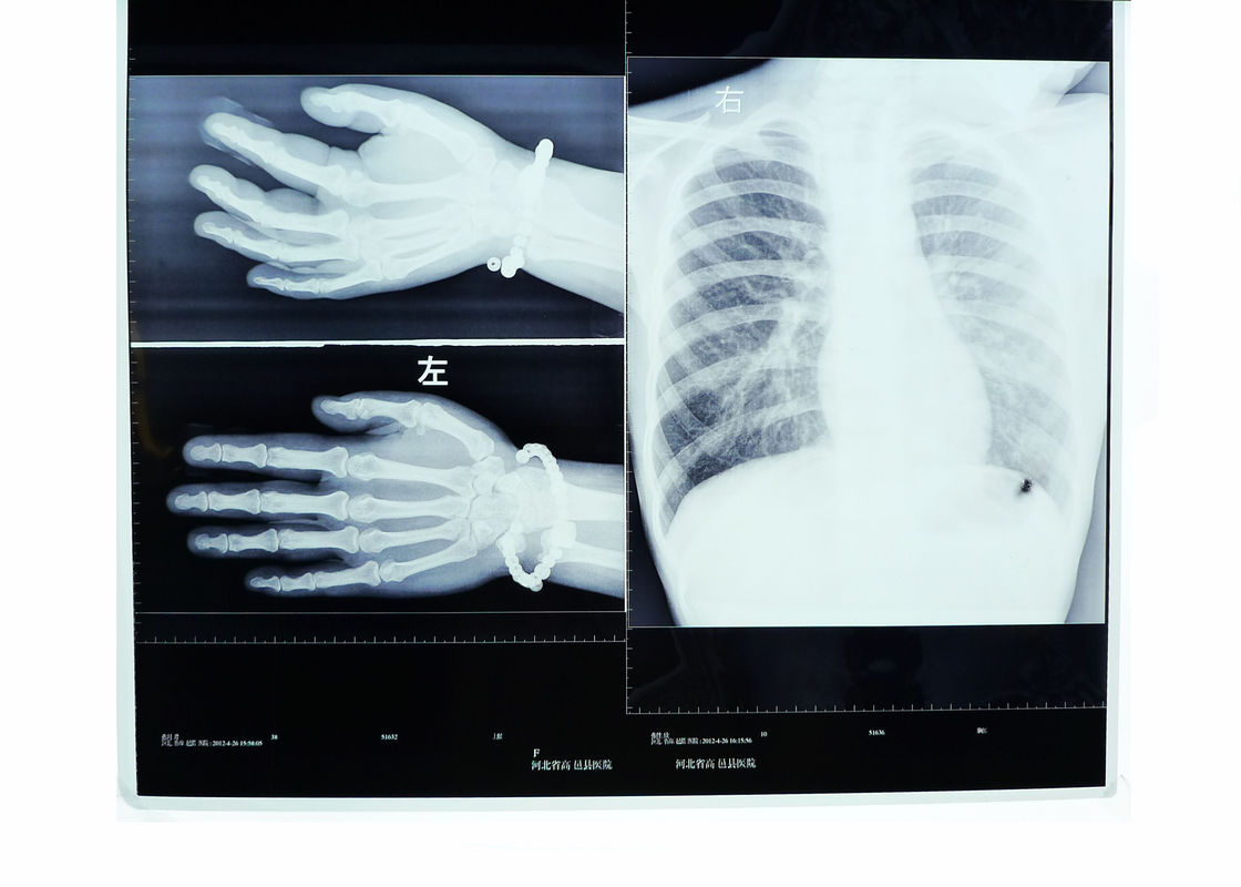 Kabut Rendah 14in * 17in Pencitraan Medis Dry X-ray Transparency Thermal Printer Film