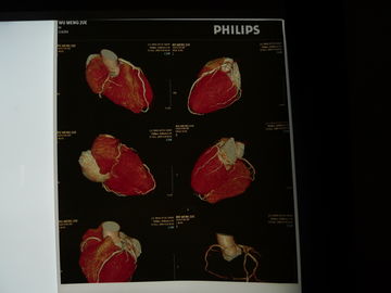 Good price 35cm x 43cm Medis Dry Imaging Film, Transparency Chest X-ray Film on line