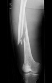 Good price Konida Dry Medical X-Ray Film 8in x 10in Untuk Agfa Drystar on line