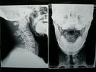 Film Pencitraan Medis Kepadatan Tinggi X-Ray Kering Untuk Fuji 3000/2000/1000