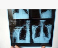 Silk Screen Medical Inkjet Film Permukaan Mengkilap Tahan Air