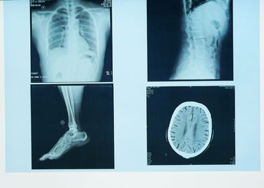 Pencitraan Diagnostik Sinar X yang Tahan Lama, 32 cm x 43 cm Kertas Medis Laser Blue X Ray Film