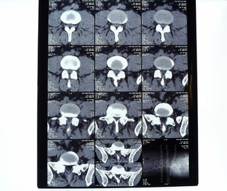 Good price 8in * 10in 14in * 17in Film Cetak Thermal Thermal Medis dengan Kepadatan Tinggi on line