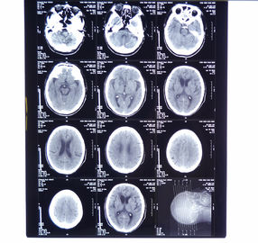 Good price 11in * 14in X-ray Dry Medical Imaging Film KND-A Untuk AGFA 5300, 5302, 5500, 5502, 3000 on line