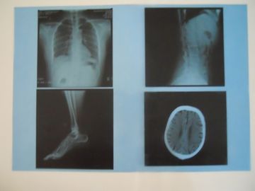 KND-A Low Fog Medical Dry Imaging Film Untuk Pemeriksaan X Ray Pada AGFA 5300/5302/5500