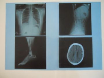 Good price KND-A Low Fog Medical Dry Imaging Film Untuk Pemeriksaan X Ray Pada AGFA 5300/5302/5500 on line