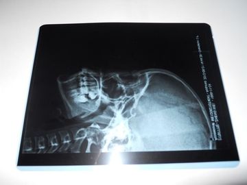 Konida Low Fog Medical Dry Imaging Film Untuk Pemeriksaan X-Ray